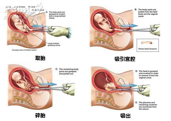 她為愛不認父母，多次墮胎後被告知再也不能懷孕，她的丈夫竟然做了這件事...