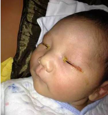 震驚！！3個月大的寶寶眼睛竟然瞎掉，全因家長的朋友一時忘記關掉....