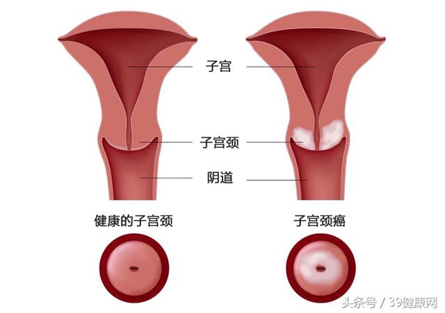 一種病不治好，你等來的可能就是宮頸癌！