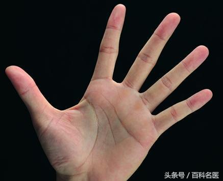 手掌泄露的身體秘密：手掌出現這8種症狀或是大病的徵兆，你有嗎