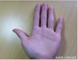 手掌泄露的身體秘密：手掌出現這8種症狀或是大病的徵兆，你有嗎