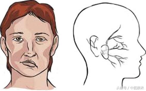 中風口眼歪斜試試這個驗方，只要一味藥