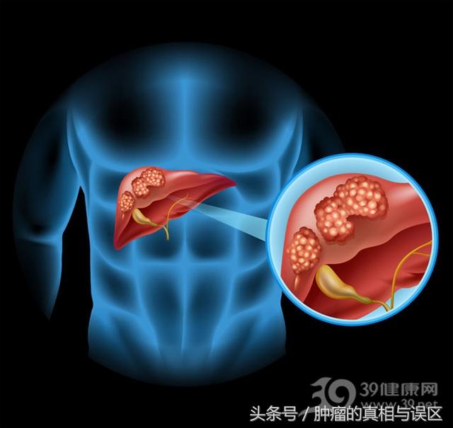 這種癌症，竟會通過吃飯傳染？別等中招才知道！