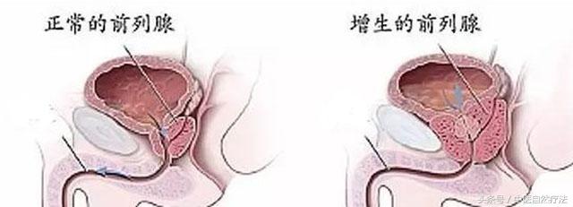 陽痿、早泄不要再藏著了，可能是前列腺疾病惹的禍