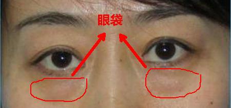 教你輕松祛眼袋去眼袋的最好方法，幫你解決掉惱人黑眼圈