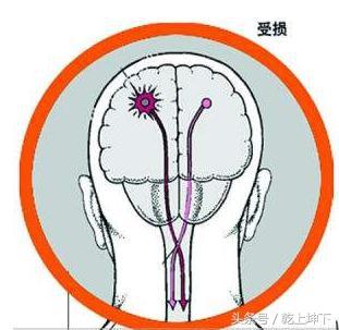 有了這些徵兆，可能是腦卒中正在襲來