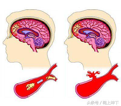有了這些徵兆，可能是腦卒中正在襲來