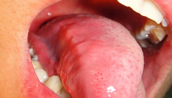 破解 吃飯老是「咬到舌頭」嗎？沒想到竟然是這種疾病的前兆....太可怕了！