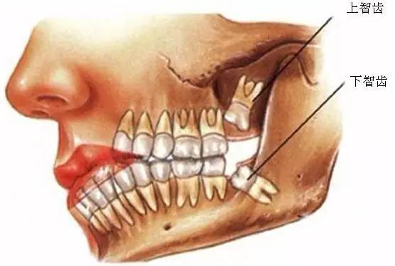 為什麼十個牙醫九個建議你「拔智齒」？看完這個我被嚇到了......尤其是「這類人」要注意了！