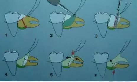 為什麼十個牙醫九個建議你「拔智齒」？看完這個我被嚇到了......尤其是「這類人」要注意了！
