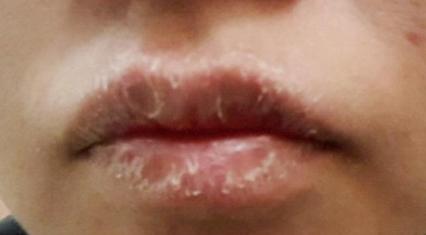 嘴唇這6種狀態暗示身體的「6種問題」，第4種最嚴重，特別是女性······