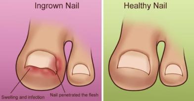 「腳趾甲內嵌」真的很痛苦！4個護理常識一定要知道，避免嵌甲惡化！