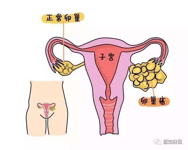 身體出現這6個信號別不當回事，當心是卵巢癌發出的警告！