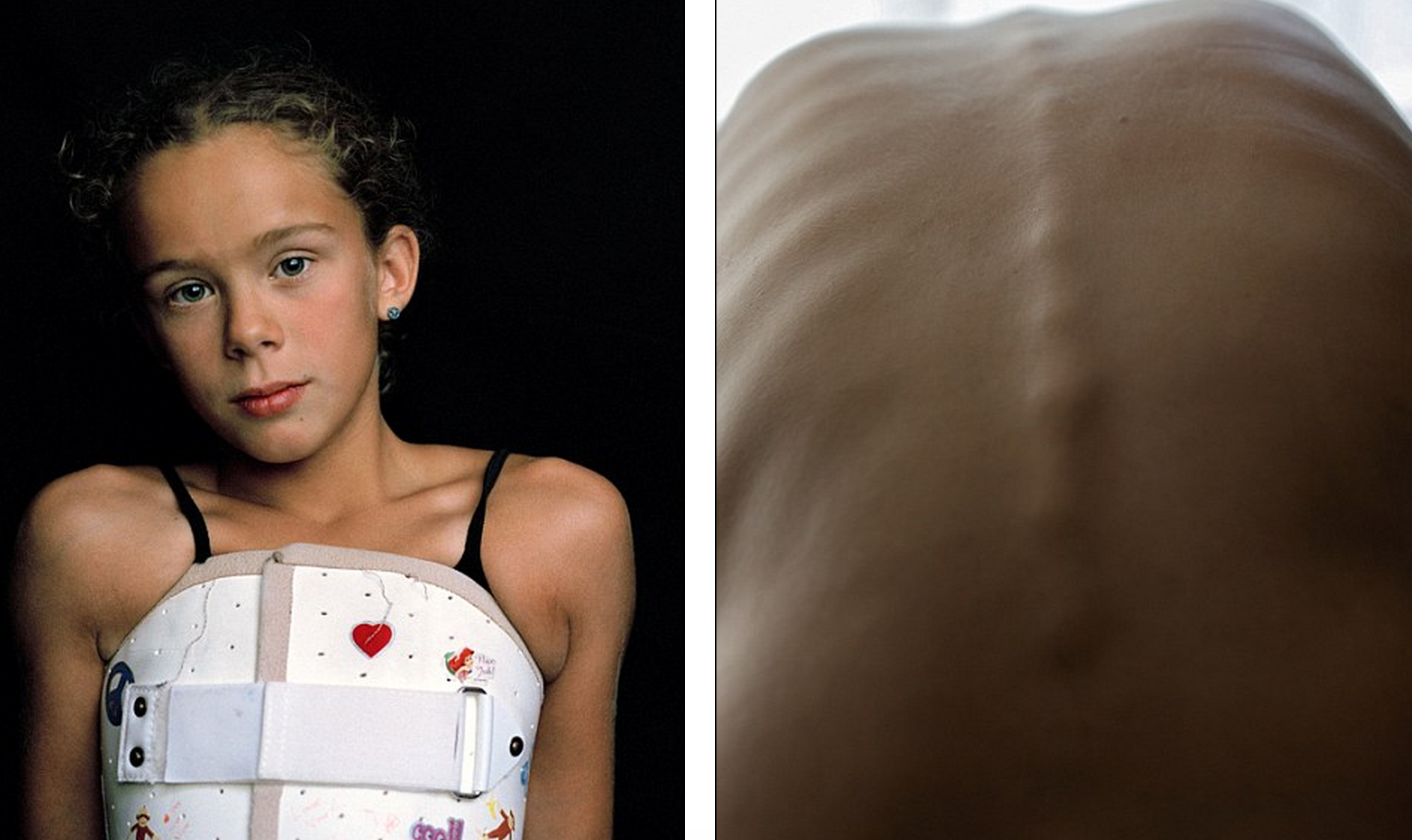 9岁小女孩脊椎侧弯超过70度,艰苦但勇敢的治疗人生全都被记录下来了.