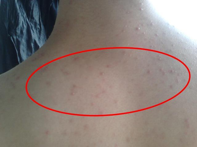 马拉色菌毛囊炎是一种毛囊性丘疹,有些还有小脓疱,乍看上去的确