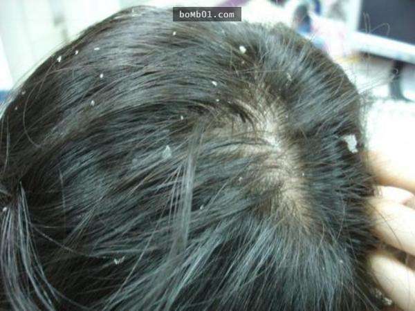 ▼细菌滋生感染:湿头发会让枕头也变潮湿,很容易让细菌在这里滋长,让