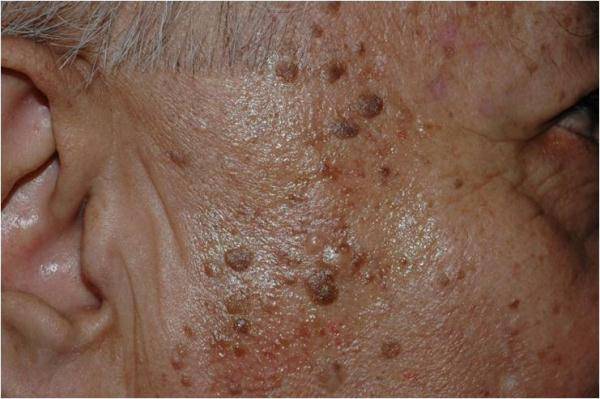 许多老年人的体表,尤其是脸部和手背布满了点点的褐斑,这是体内自由基