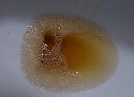 很有可能是肝受损的症状,乙肝,甲肝导致肝细胞被破坏,影响了胆红素的