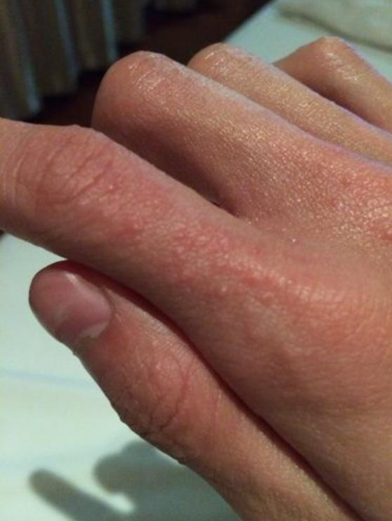 手脚长小水泡奇痒难忍?教你简单一招,轻松解决难题,省钱又省心!