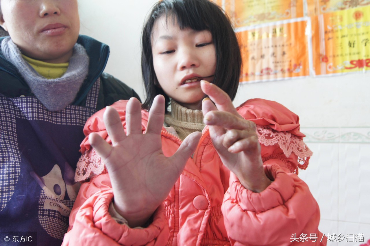 16岁花季少女患「怪病」,皮肤变黑变硬脱落,好心人义演募捐救治