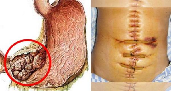 早期胃癌大便图片症状图片