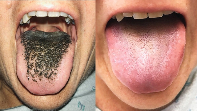 黑毛舌症状图片图片