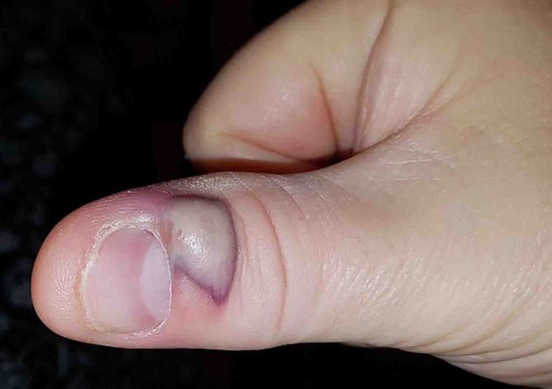 57岁阿公爱咬指甲「全身被侵蚀」 送医听到这个病症绝望了