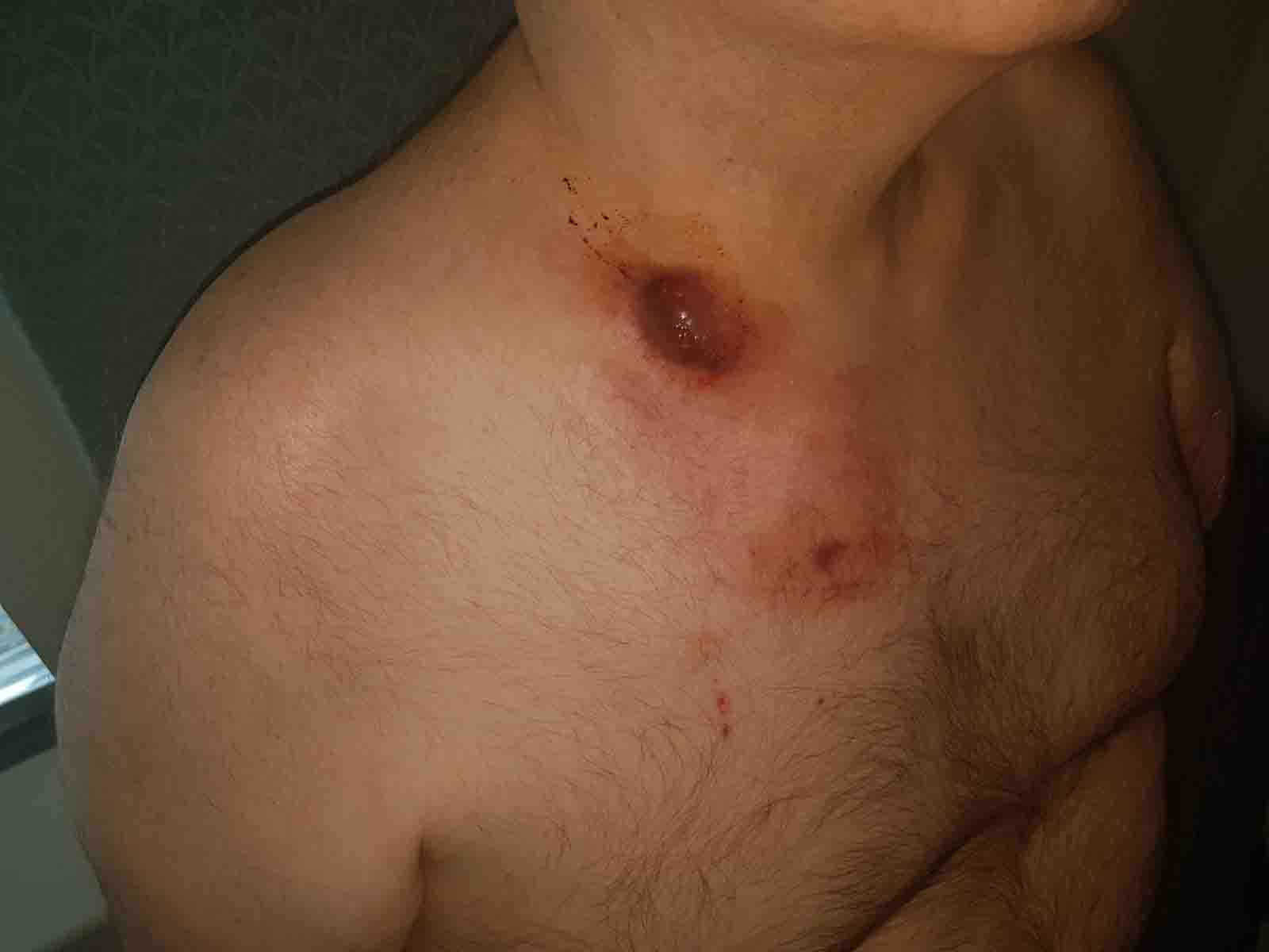 57岁阿公爱咬指甲「全身被侵蚀」 送医听到这个病症绝望了