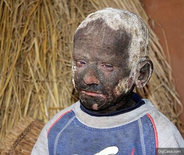 小男孩出生15天,就得了一种怪病,开始「全身石化变成雕像