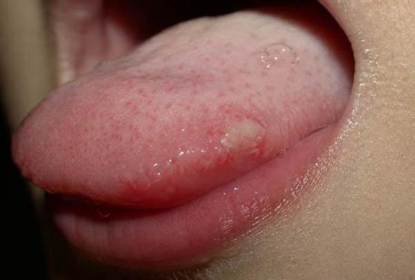 舌头上有痘痘图片图片