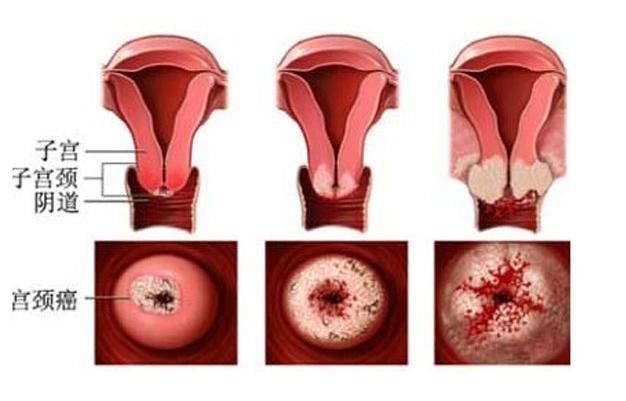 22岁女大生「便秘8周」,一度认为自己得了痔疮.