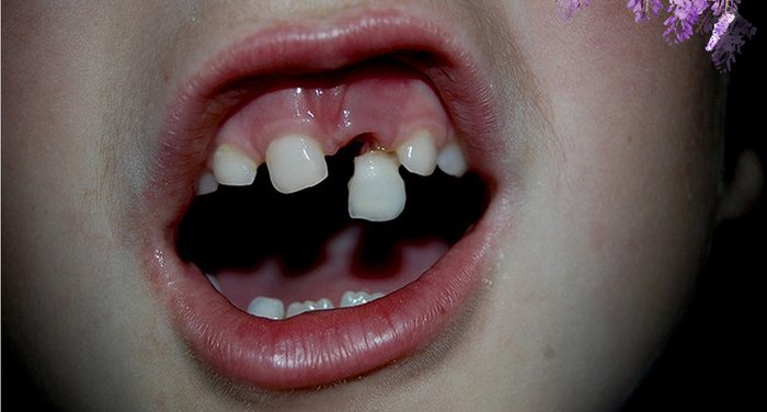 孩子断牙千万不要扔掉!它的用途很多人都不知道!