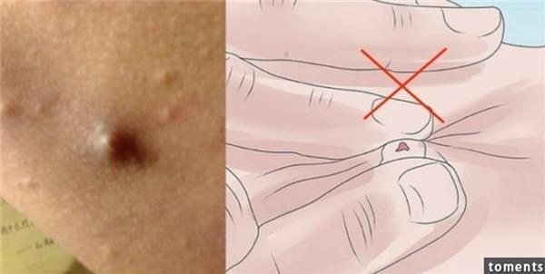 常常最容易被忽略但一摸就很痛的「粉瘤」!