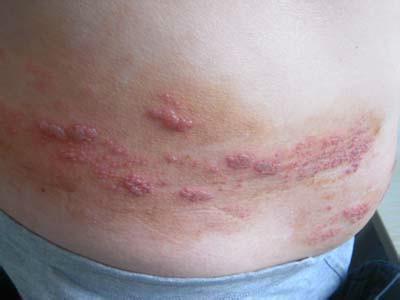 生蛇生蛇皮肤病