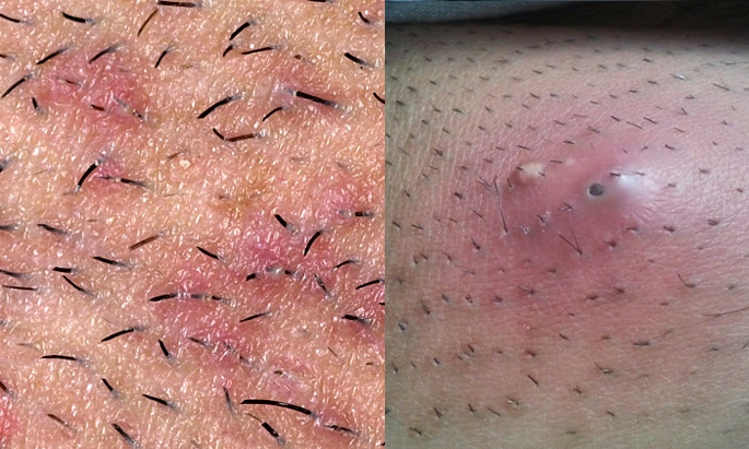 几乎是人都有长过,分享出去功德无量!