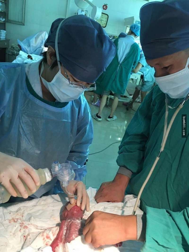 双胞胎男婴早产3个月随时都会失去性命,但医生冷静地一拿出保鲜膜就