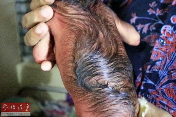 新生儿长满皱纹似「老人」,背部更是恐怖!