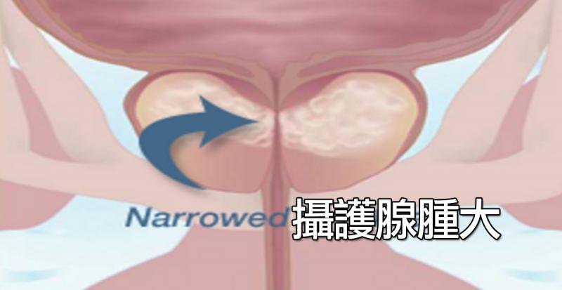 三招立治「攝護腺」腫大,「四不吃」解除下半身危機!