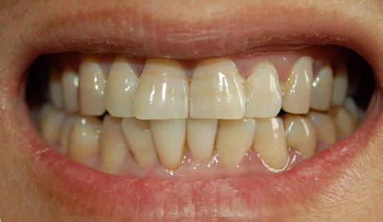 牙齿黄怎麼办!三招教你黄牙变白牙