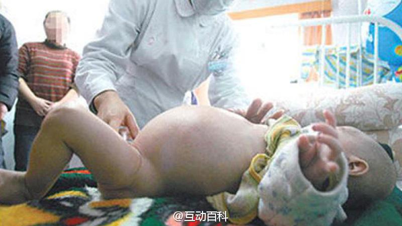 出生9天的女嬰肚裡竟然懷著一個胎兒
