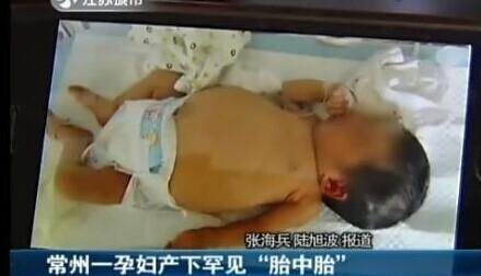 出生9天的女嬰肚裡竟然懷著一個胎兒