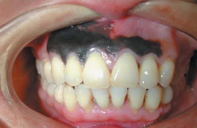牙齒上出現這種症狀，你就要小心腫瘤了！