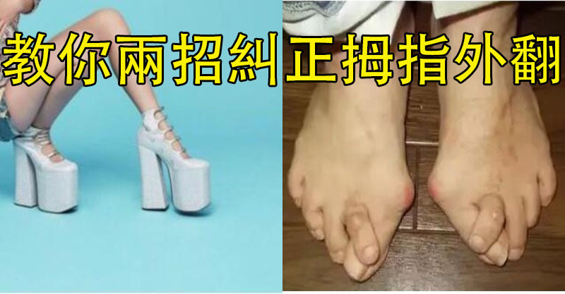 但是看到「拇指外翻」你还敢穿这麼高吗?教你两招纠正拇指外翻!
