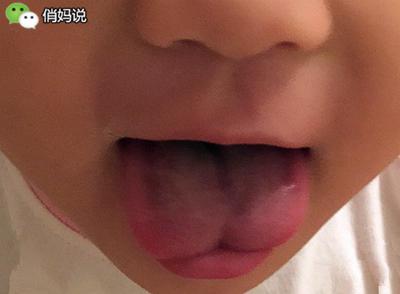 快看看你家寶寶是這種舌頭嗎？如果是，要小心了！