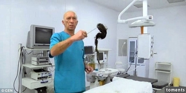 驚聞外科醫生取出頭髮的質量，稱為毛團，在塔拉茲，哈薩克斯坦醫院