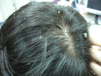 頭髮油膩難忍，這些去除頭皮屑的小偏方趕緊收著!