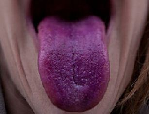 9種舌頭顏色讓你看出你搞不好早就已經罹患的「嚴重身體疾病」。