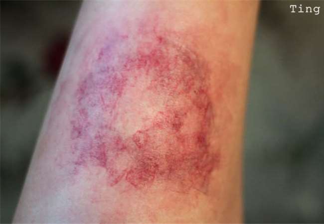但如果受伤的比较严重,也可能会直接跳过红色的阶段,直接在皮肤上