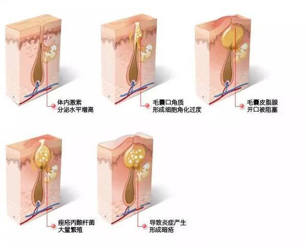 揭秘痘痘成因，幫你徹底解決痘痘問題，還你健康皮膚