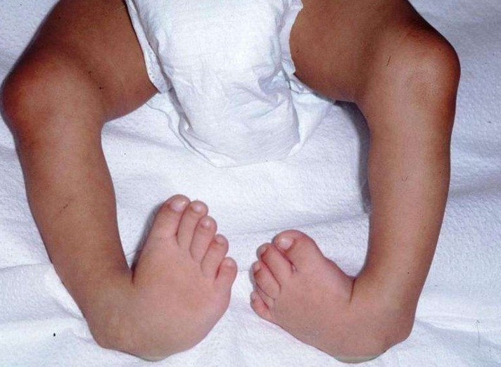 宝宝小腿弯曲的正常图图片